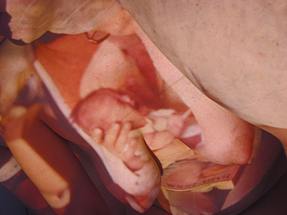Neonatal_1