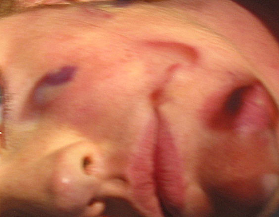 Neonatal_14