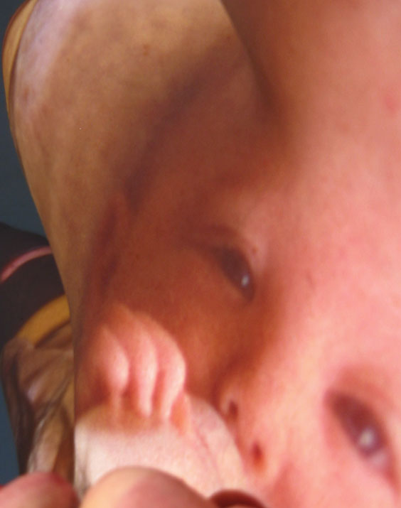 Neonatal_10