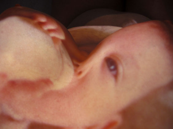 Neonatal_2